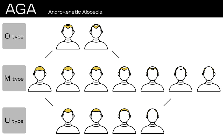 生え際後退の種類は2タイプある