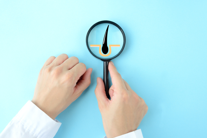 生え際が後退する原因は進行性のあるAGAだった!