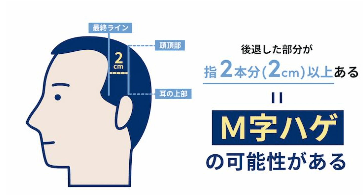 生え際後退の種類②M字