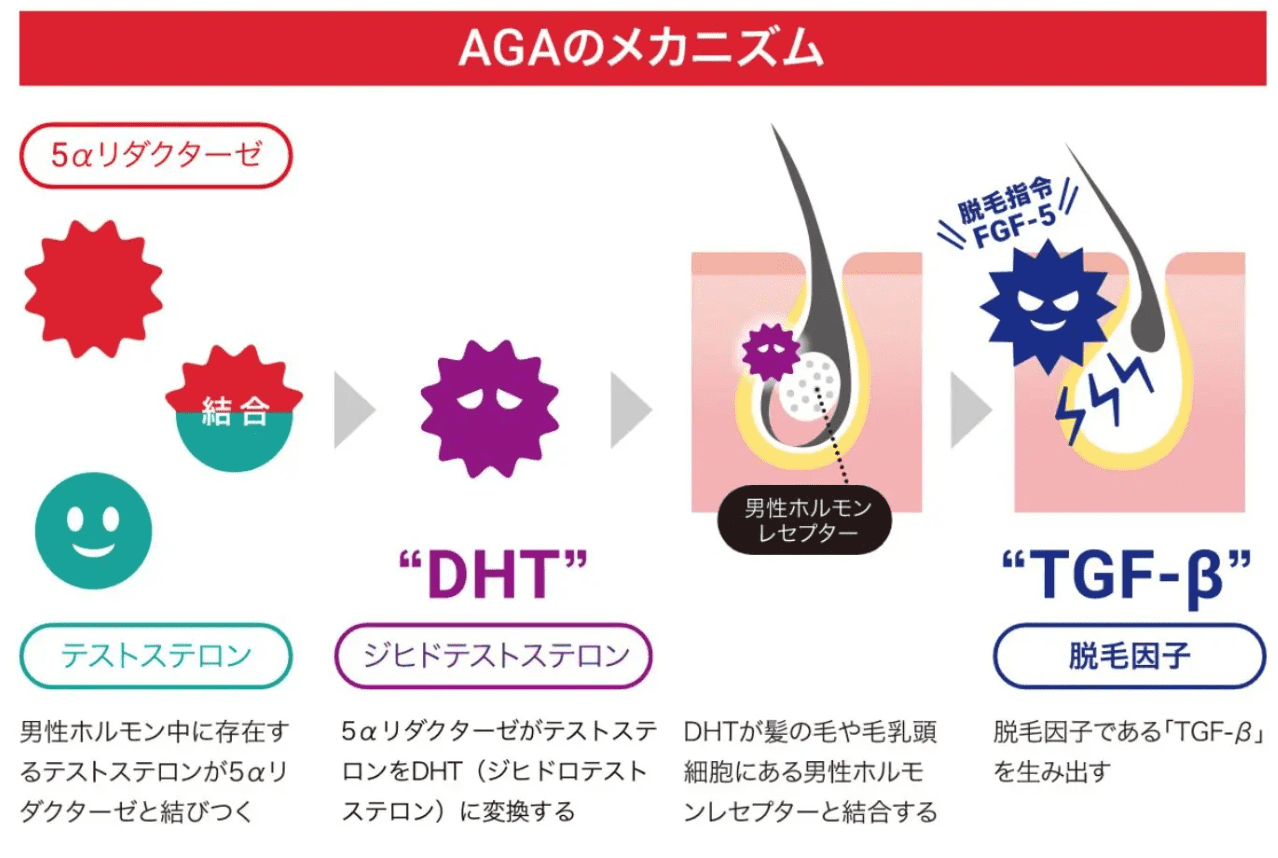 進行性の疾患「男性型脱毛症」とは