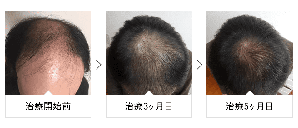 AGA治療の症例写真