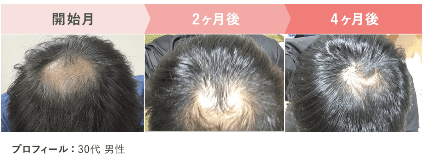 AGA治療の症例写真3